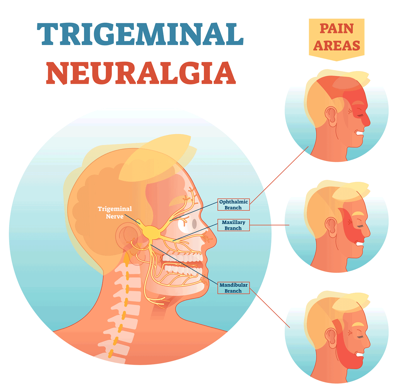 三叉神经痛（Trigeminal Neuralgia）如何医治？患有该疾病的人有自杀倾向？